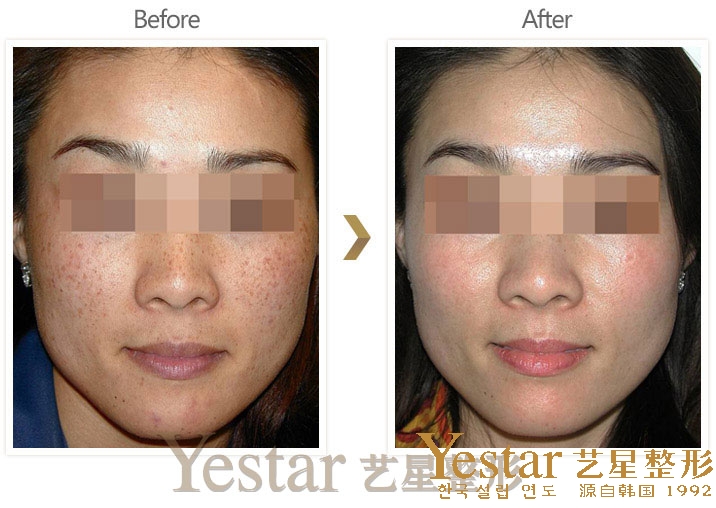 武汉激光祛斑术后注意事项