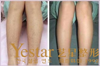 武汉激光脱腿毛好吗