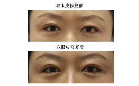 微创双眼皮整形图片