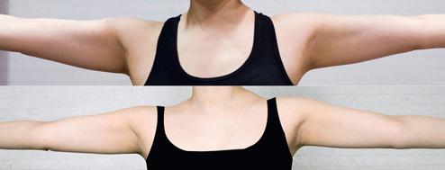 手臂吸脂术图片