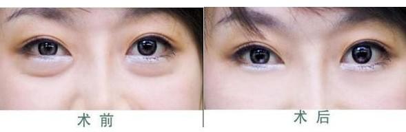 激光去眼袋