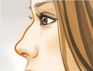 驼峰鼻术前要做什么准备