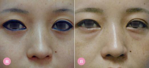 纹眼线