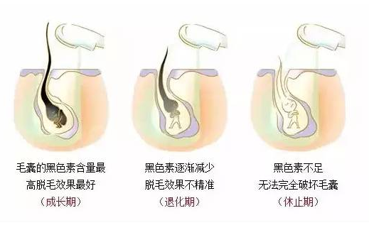激光脱毛会有副作用吗