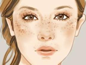 哪些人不太适合做激光去黄褐斑