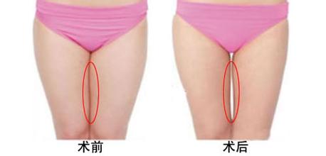做大腿吸脂术会造成皮肤松弛吗
