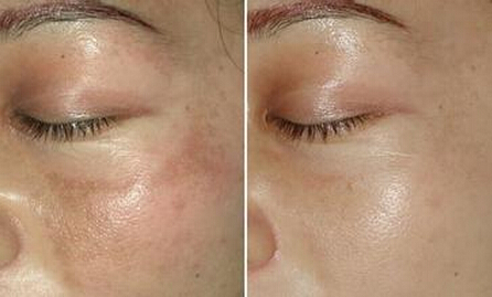 激光去黄褐斑的效果好吗