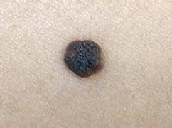 激光去色素痣后要怎么护理