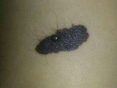 激光能去黑毛痣吗