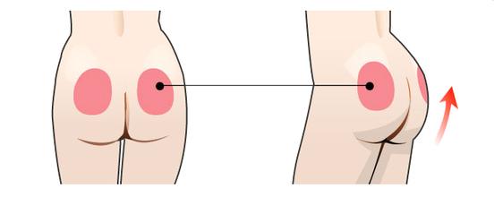 臀部吸脂有风险吗