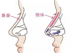 怎么判断取鼻假体后要不要换新的