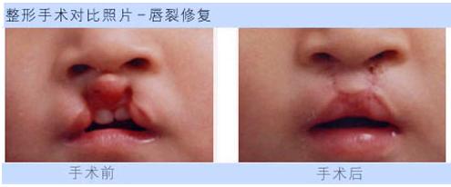 兔唇整形怎么护理