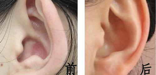 小儿矫正招风耳怎么做