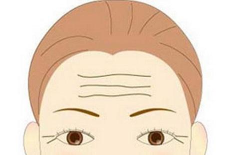 武汉像素激光去抬头纹好吗