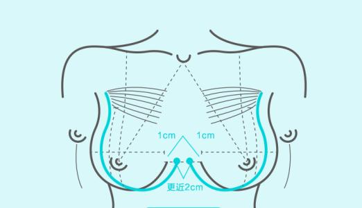 武汉丰胸术能改善乳房下垂吗