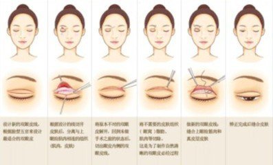 武汉做双眼皮会留疤痕吗?