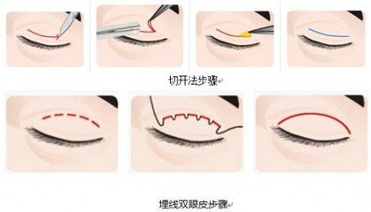 武汉埋线双眼皮多少钱?