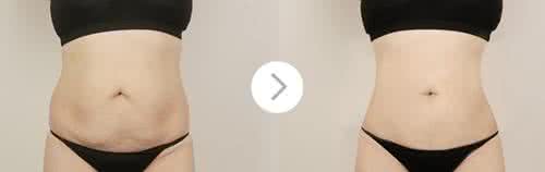 武汉腰腹部吸脂也可以减肥吗