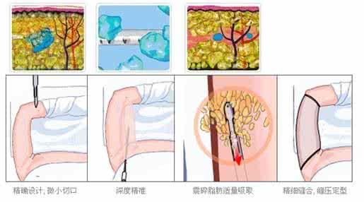 武汉腰腹部吸脂后皮肤会松弛吗?