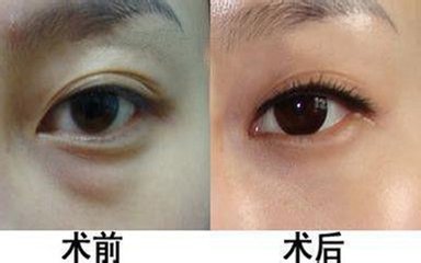 武汉外切法祛眼袋有哪些特点?