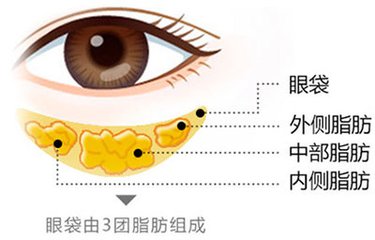 武汉吸脂祛眼袋有哪些好处?