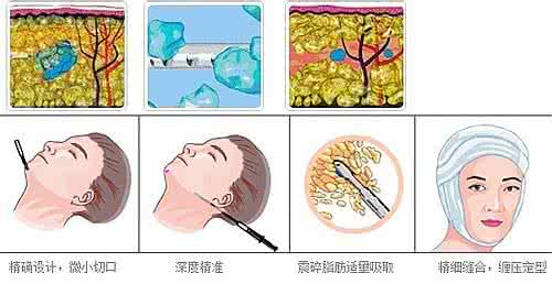 武汉面部吸脂瘦脸吗?