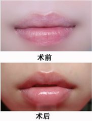 武汉玻尿酸丰唇价格贵不贵?
