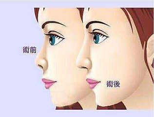 武汉隆鼻的价格大概是多少?
