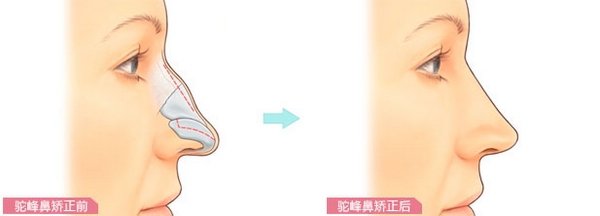 驼峰鼻明显怎么办?