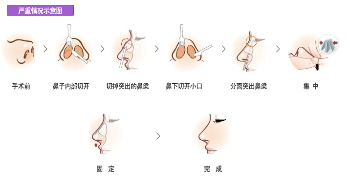 驼峰鼻明显怎么办?