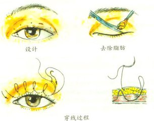 武汉做埋线双眼皮的费用大概是多少?