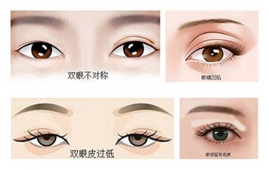双眼皮失败做修复,双眼皮失败,