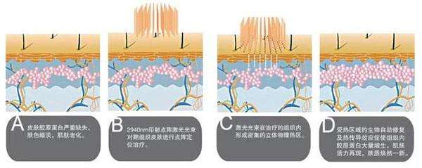 激光去痘印的价格受哪些因素的影响?