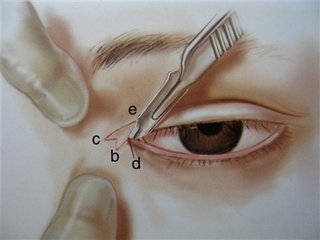 武汉开眼角选择哪家医院好?