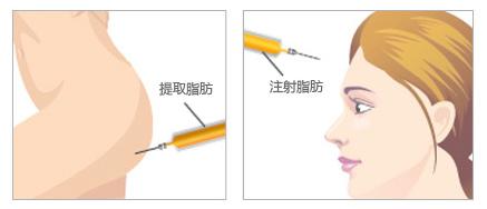 武汉自体脂肪丰额头会不会留下疤痕?