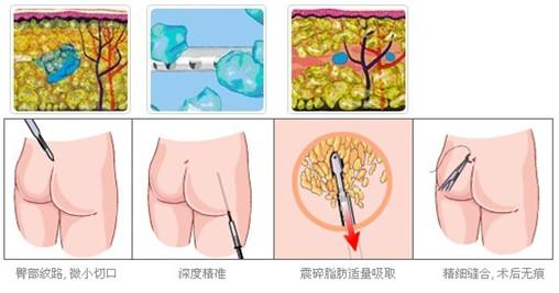 怎样快速有效减掉臀部多余赘肉?