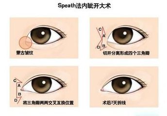 武汉开内眼角手术大概需要多少钱?