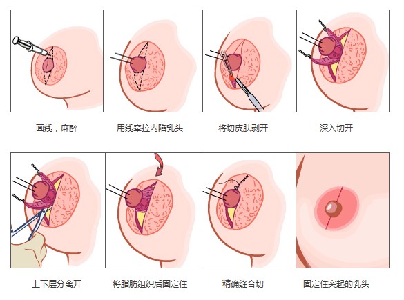 武汉乳头凹进去了该怎么办?