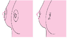 武汉做完乳头内陷矫正术后的注意事项?