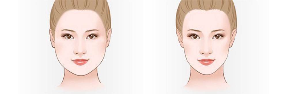 武汉注射瘦脸后怎么护理