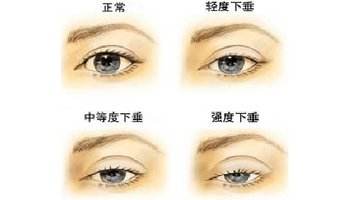 武汉上眼睑松弛有什么表现