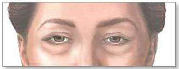 武汉眼袋手术后会反弹么