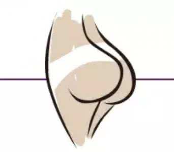 武汉臀部吸脂后效果好不好