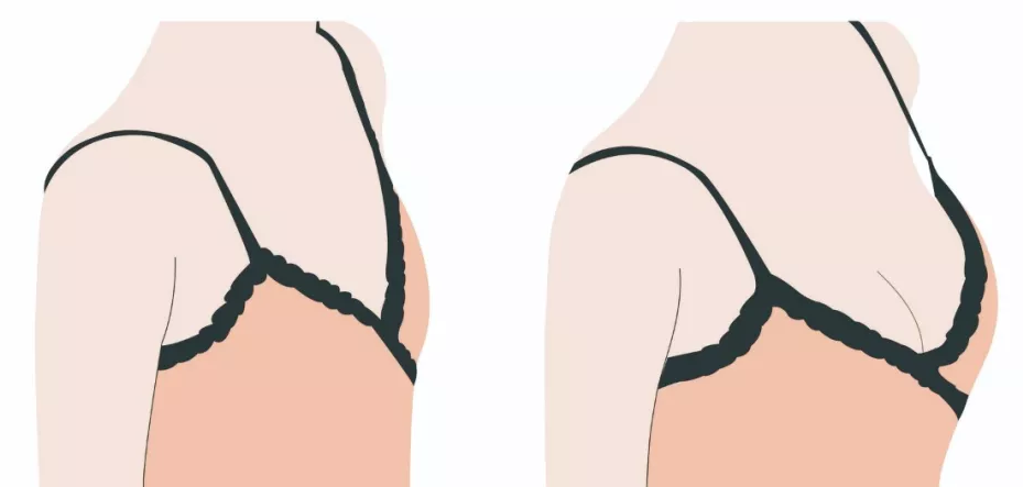 武汉隆胸假体能维持多久