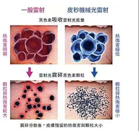 武汉皮秒激光祛斑多少钱
