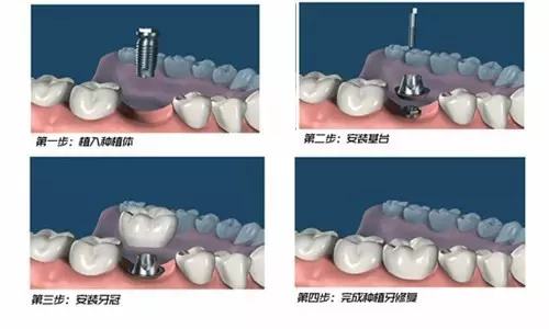 武汉种植牙会不会很麻烦