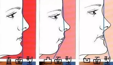 武汉鼻基底凹陷怎么改善