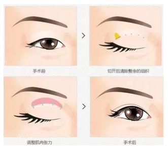 武汉双眼皮手术多久恢复