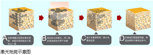 武汉超皮秒祛雀斑效果好吗
