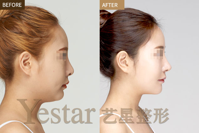 Yestar艺星生态纳米隆鼻术 打造精致美鼻